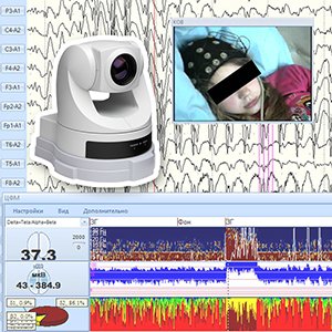 Комплект видеооборудования для ЭЭГ-видеомониторинга и ПМО 